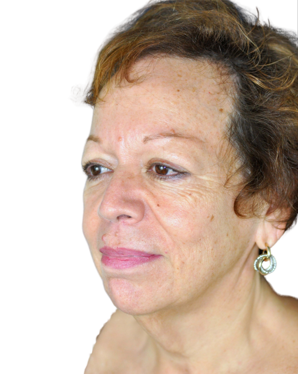 Facelift / Neck Lift