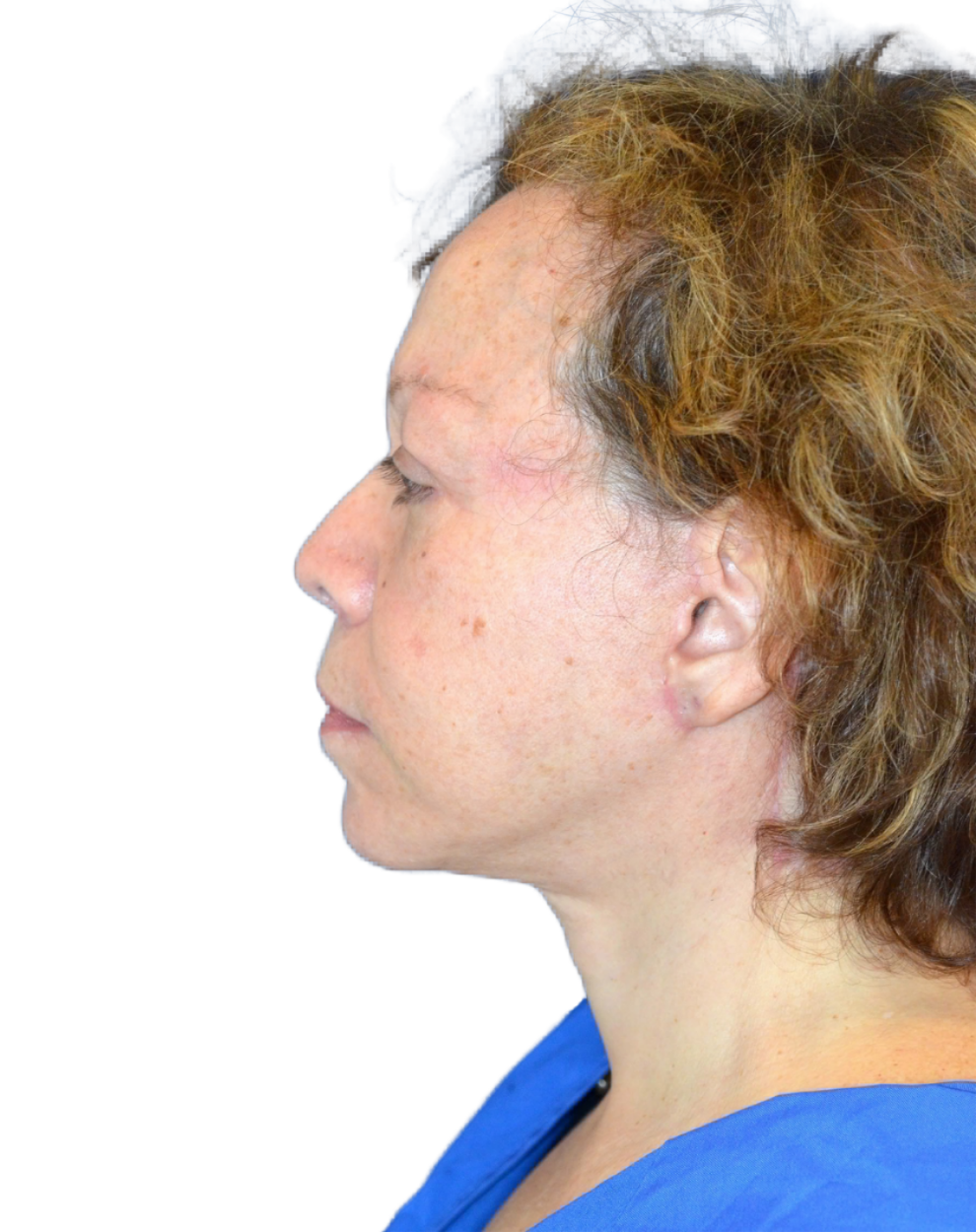 Facelift / Neck Lift
