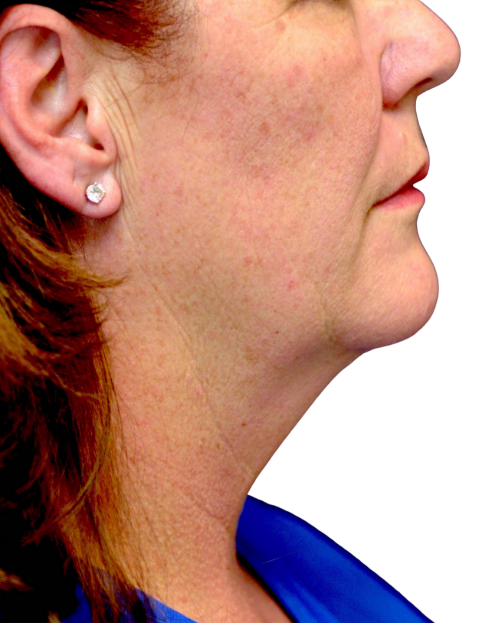 Facelift / Neck Lift