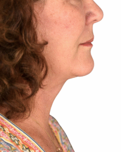 Le Spa Plastic Surgery Before and After Photos