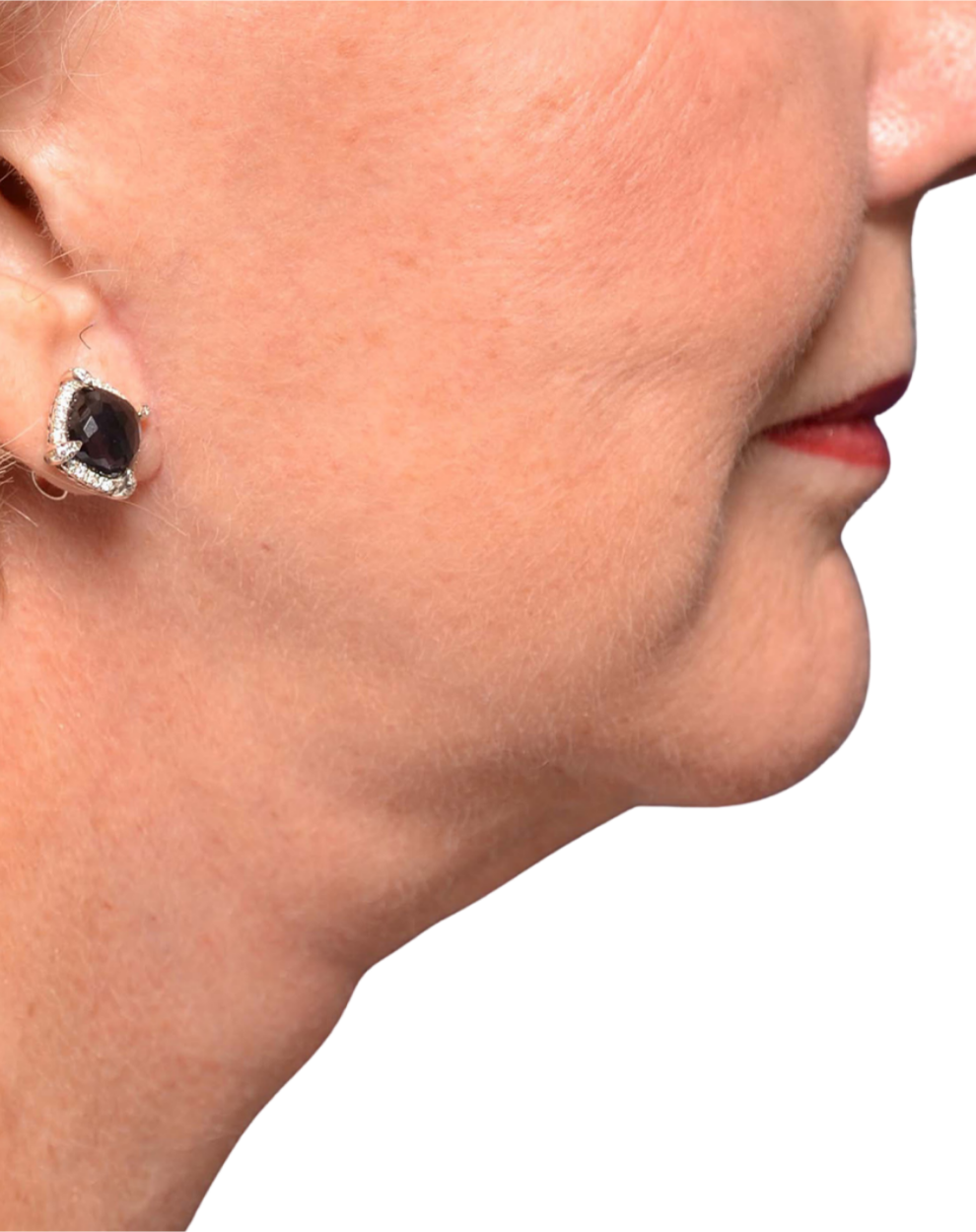 Facelift / Neck Lift