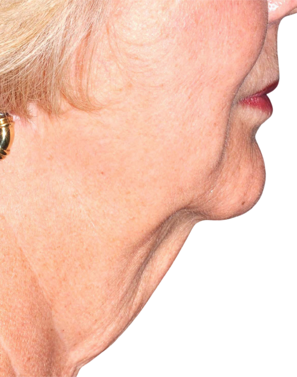 Facelift / Neck Lift