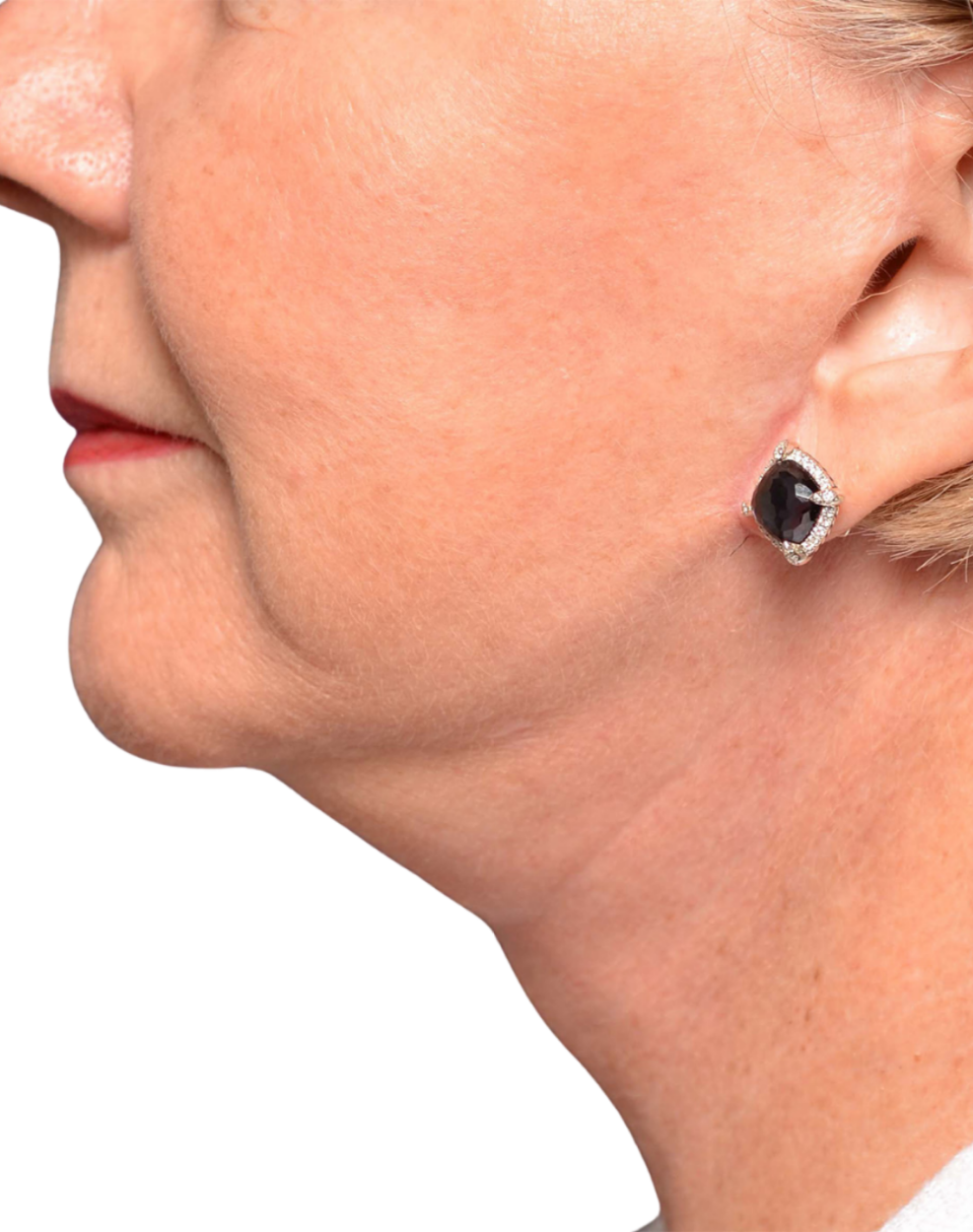 Facelift / Neck Lift