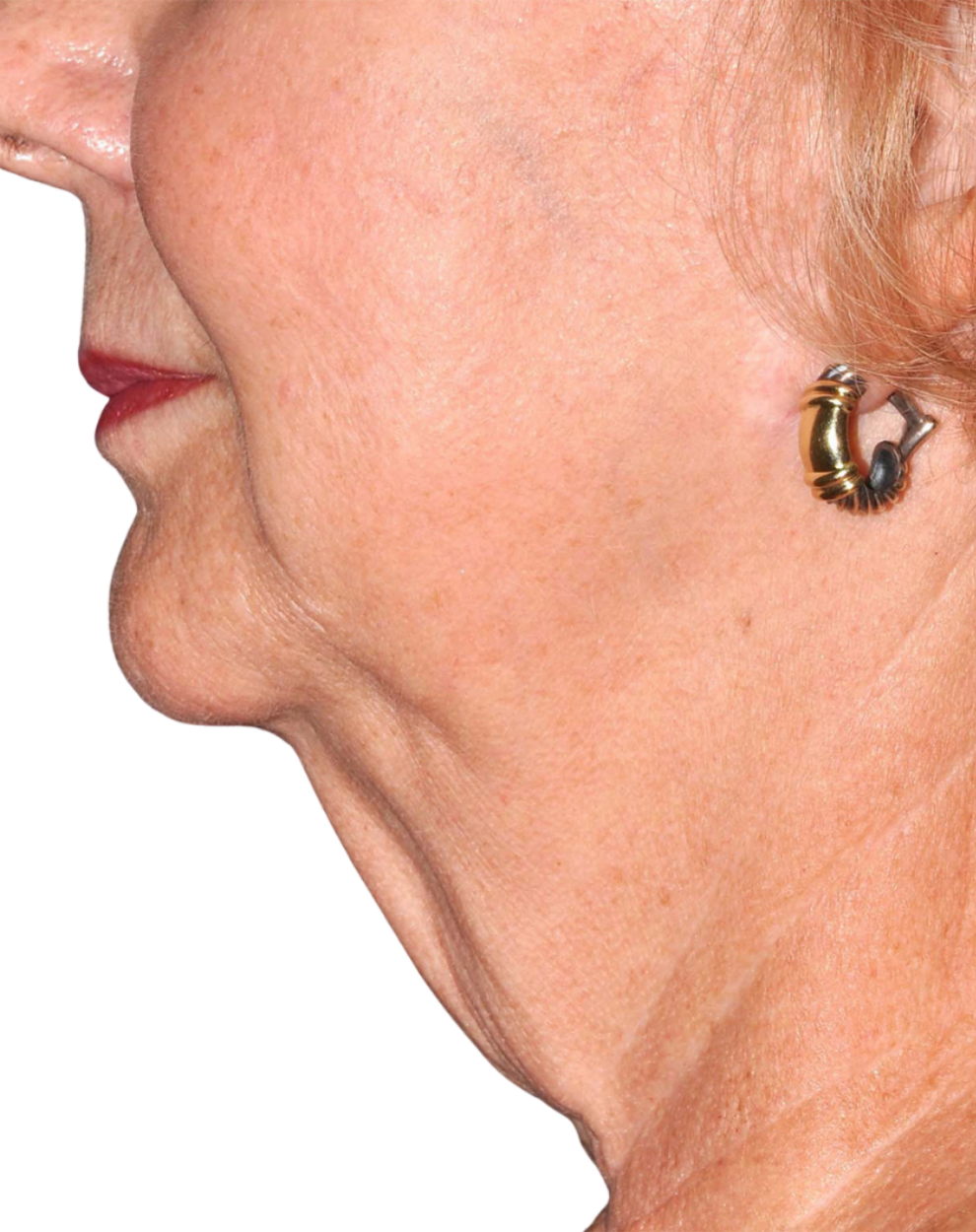 Facelift / Neck Lift