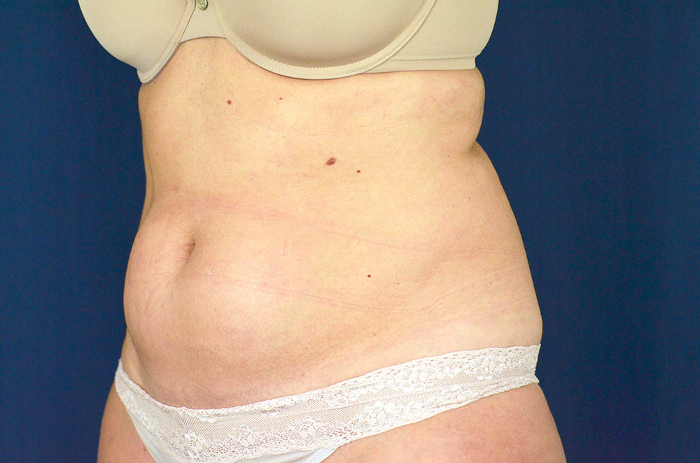 Liposuction