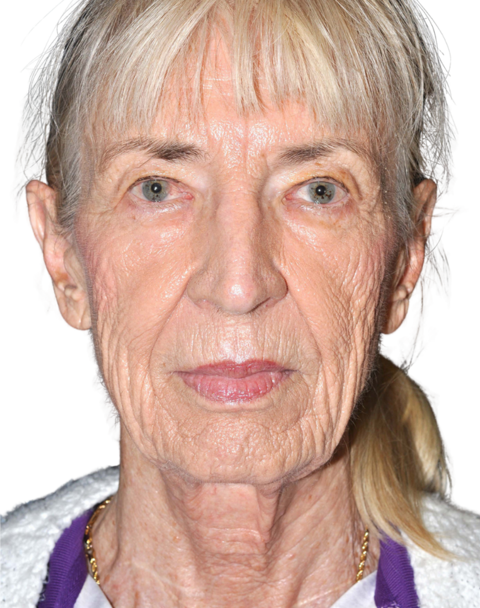 Facelift / Neck Lift