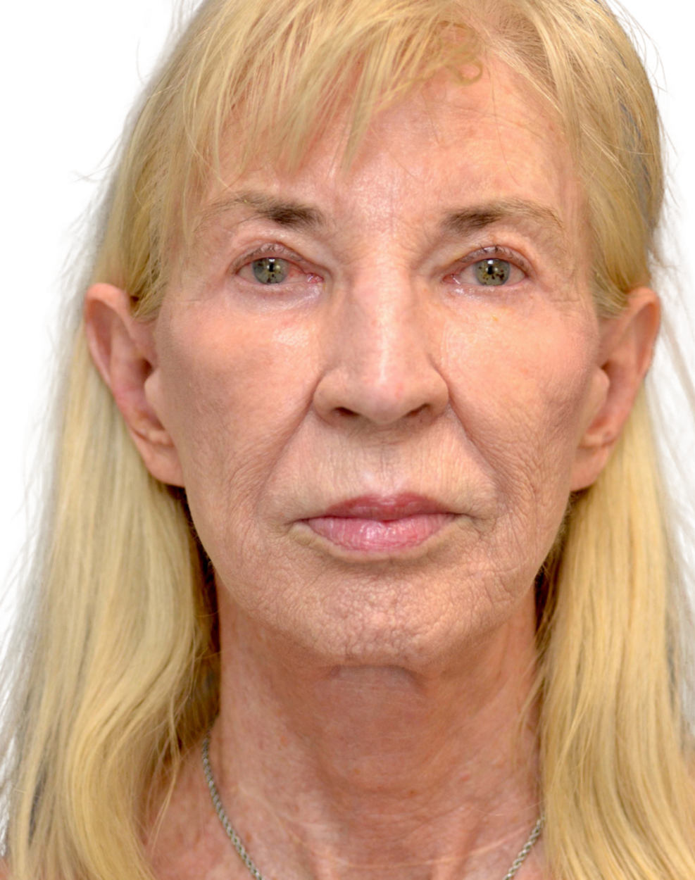 Facelift / Neck Lift