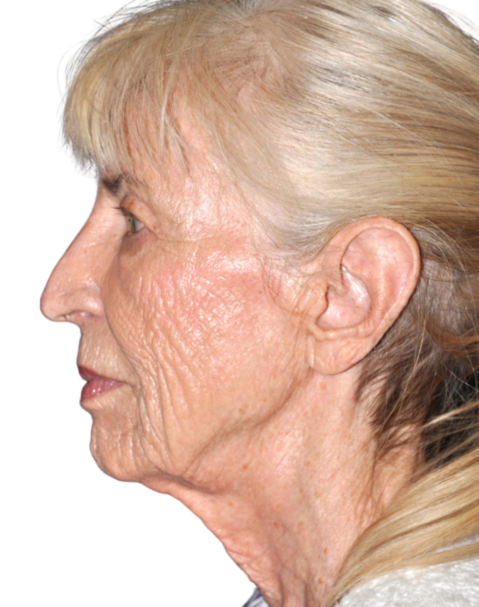 Facelift / Neck Lift