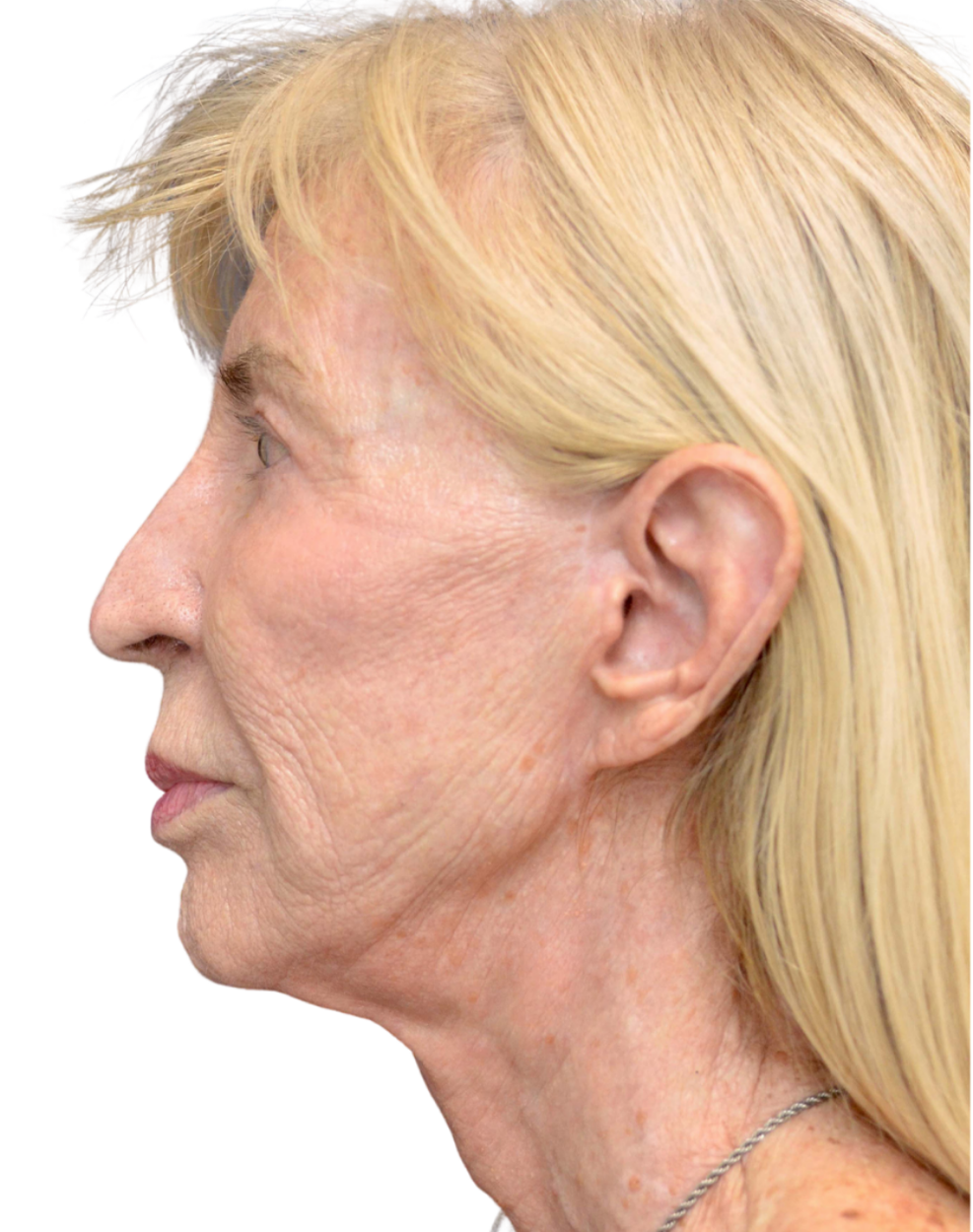 Facelift / Neck Lift