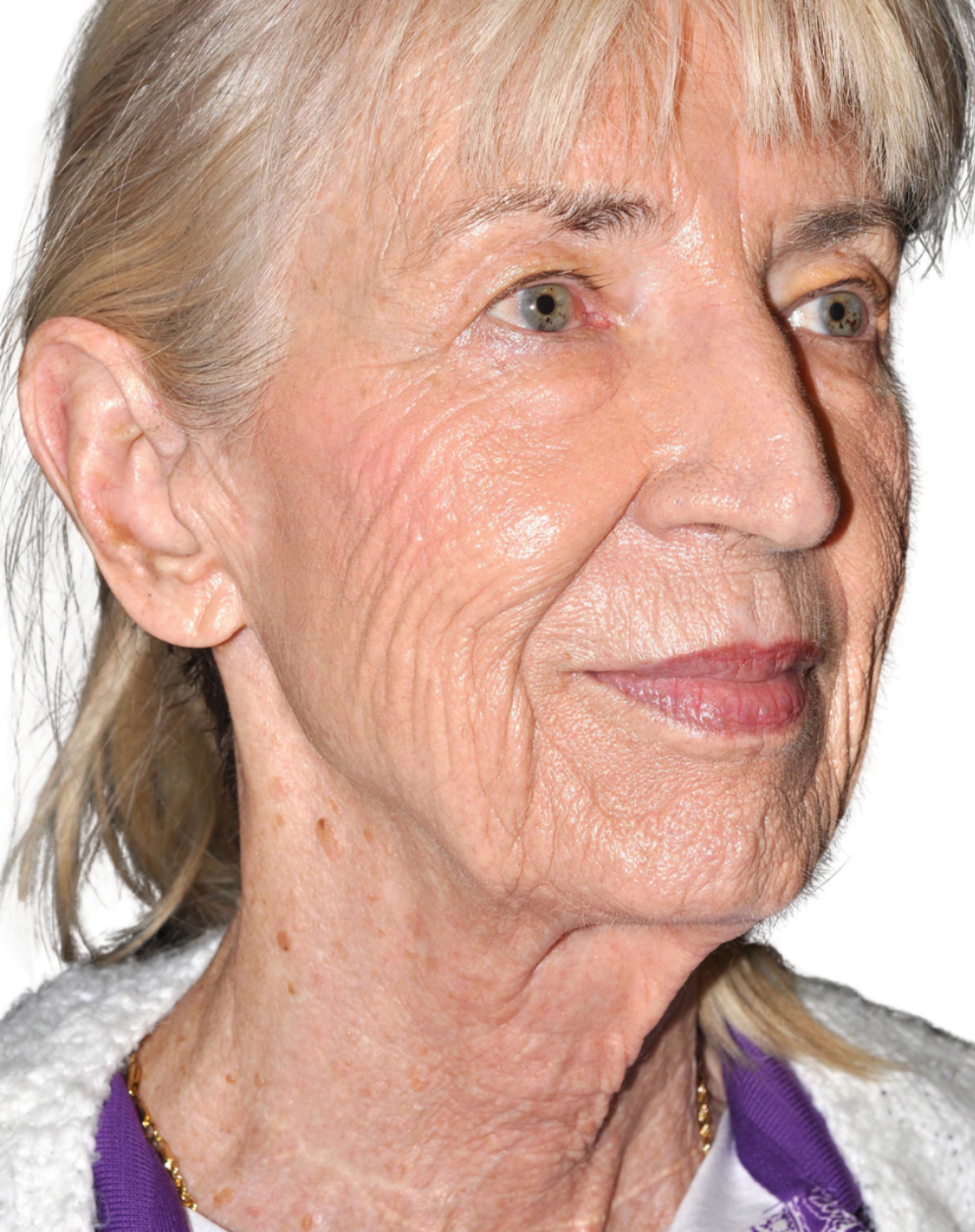 Facelift / Neck Lift