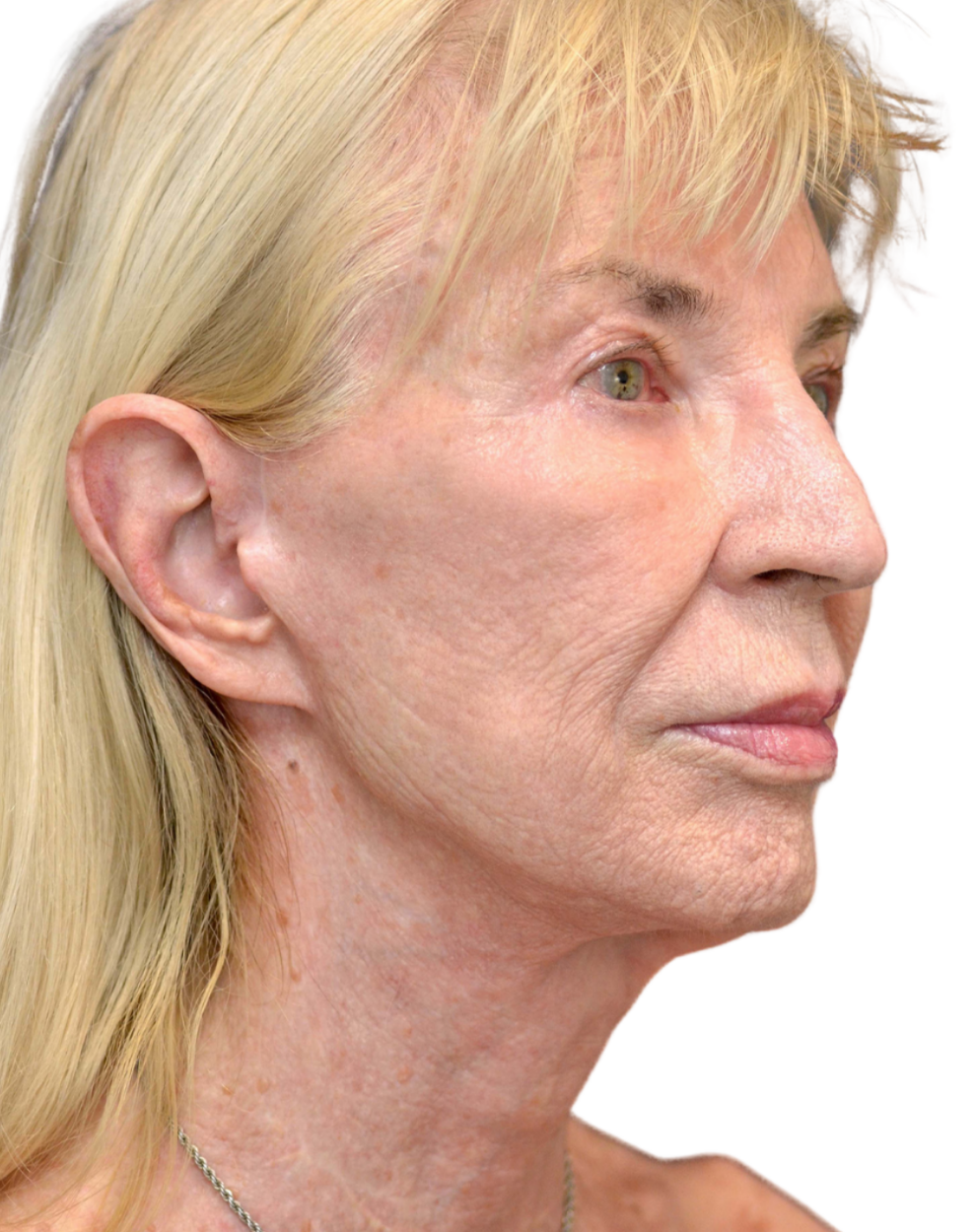 Facelift / Neck Lift