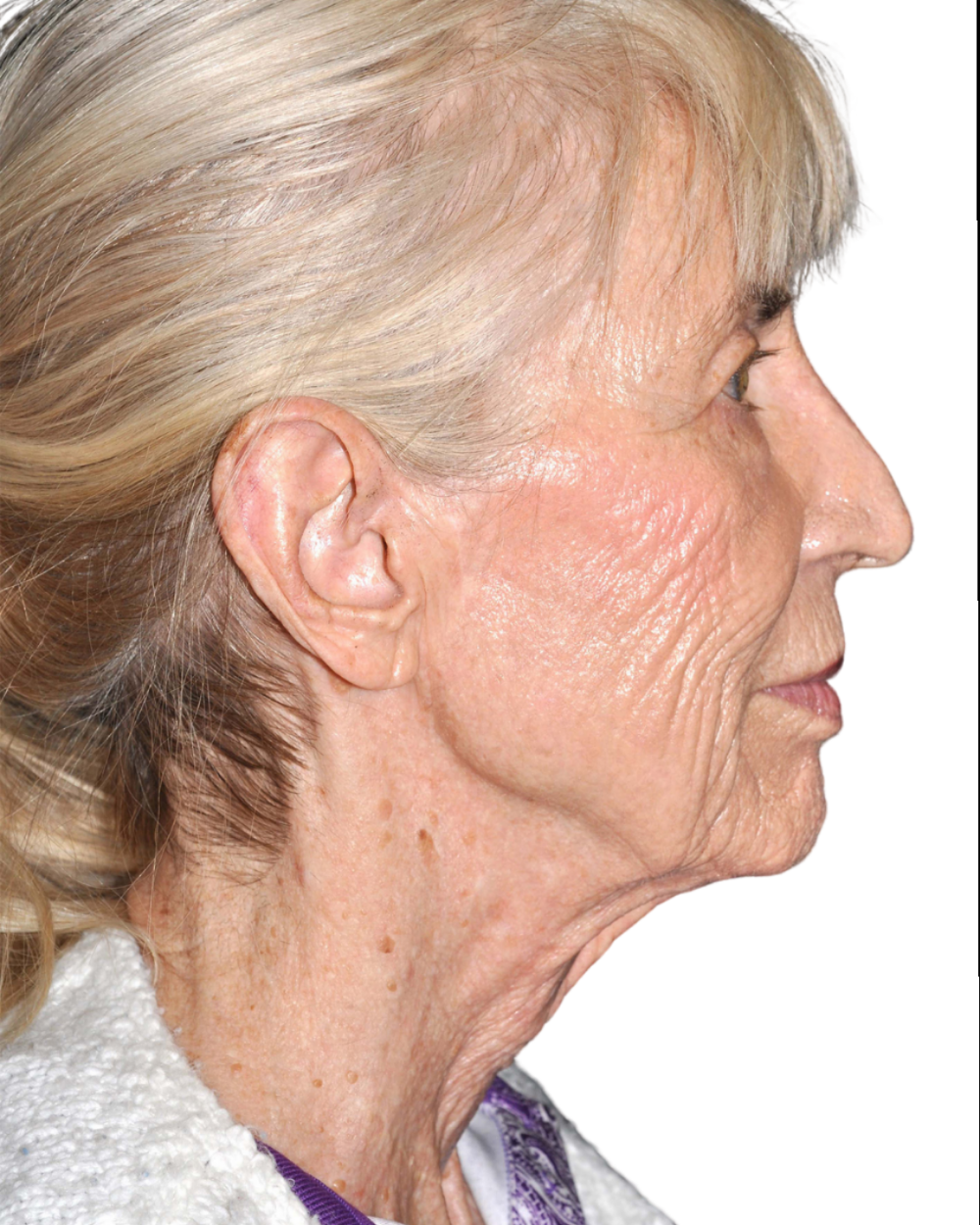 Facelift / Neck Lift