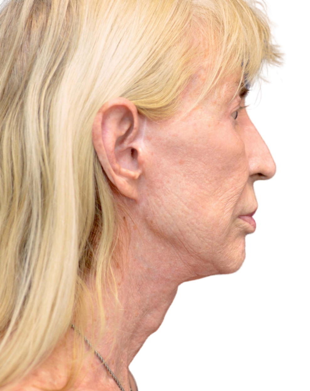 Facelift / Neck Lift