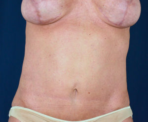Le Spa Plastic Surgery Before and After Photos