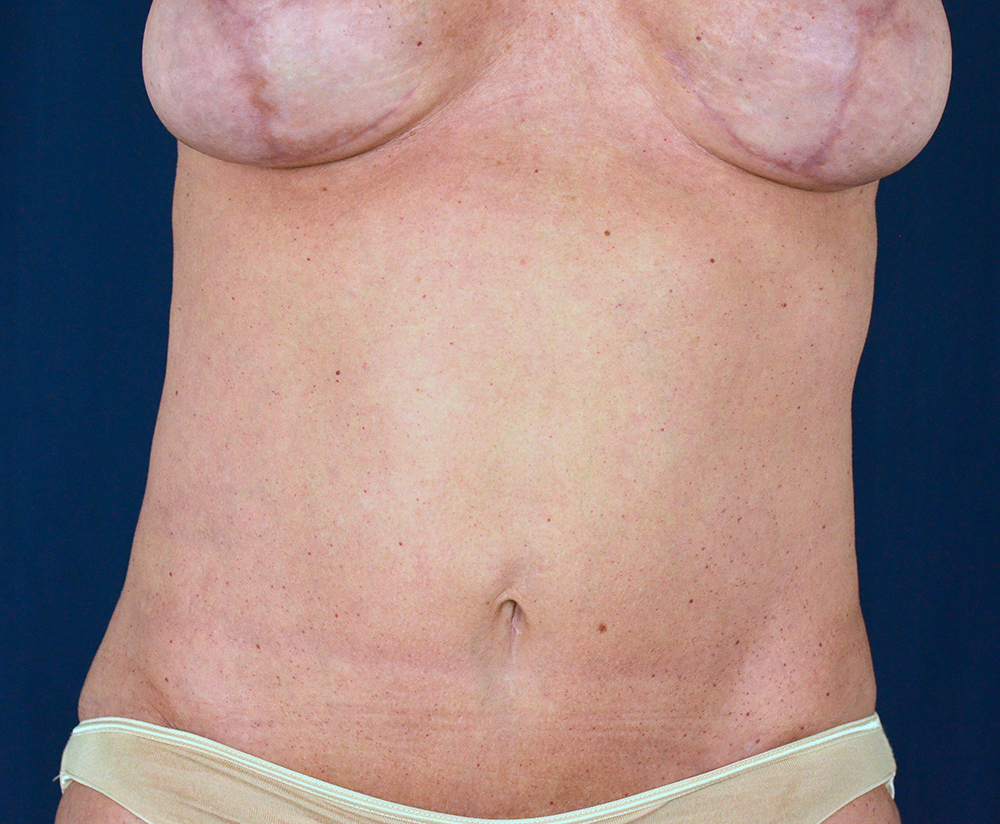 Tummy Tuck