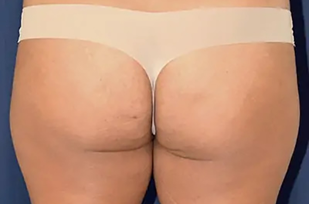 Brazilian Butt Lift