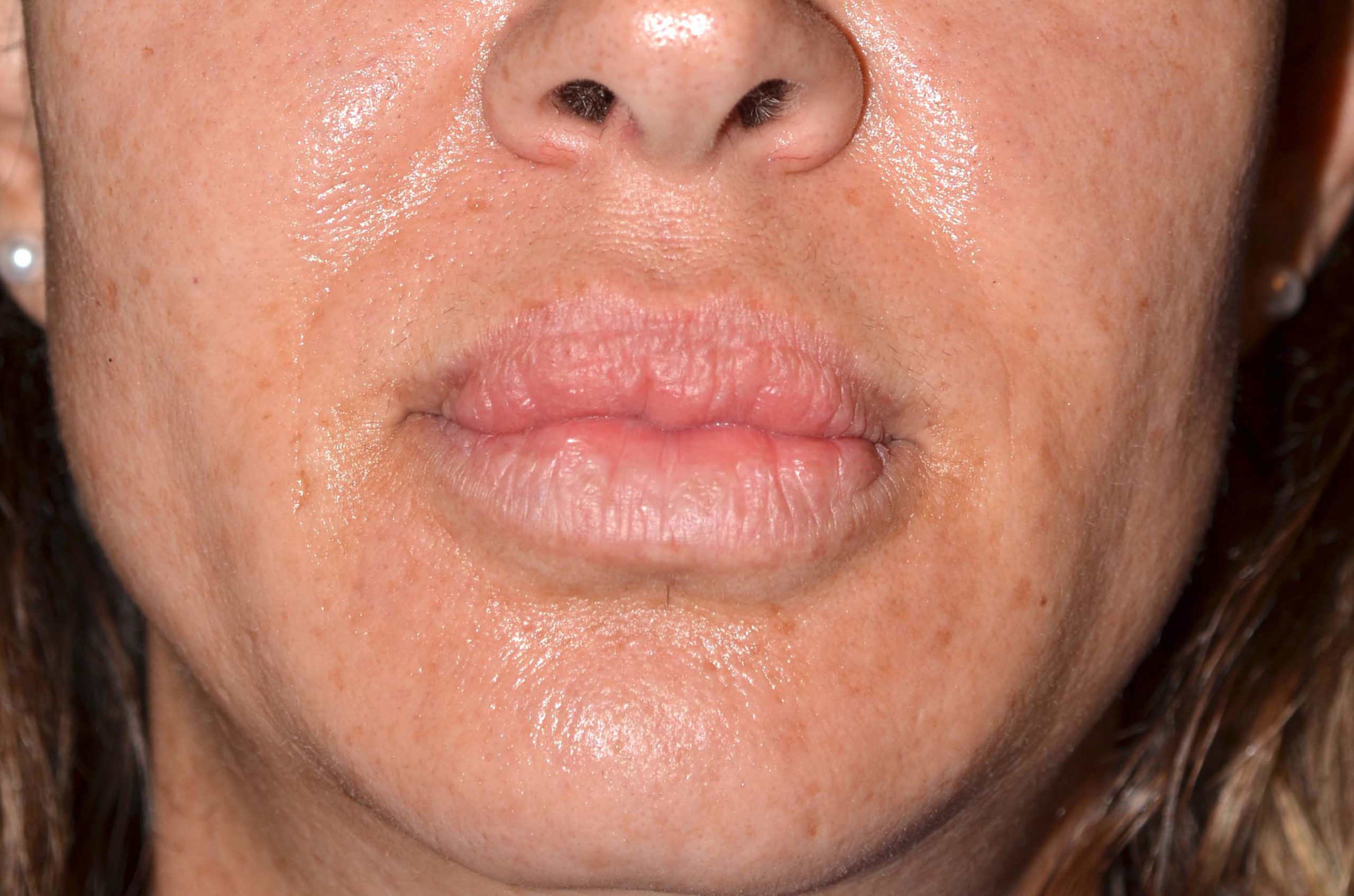 Lip Augmentation / Lip Lift