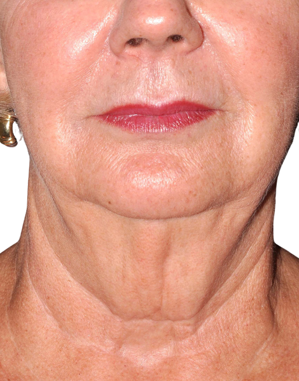 Facelift / Neck Lift