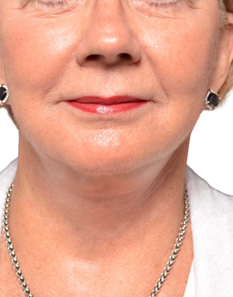 Facelift / Neck Lift