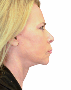 Le Spa Plastic Surgery Before and After Photos