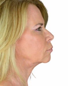 Le Spa Plastic Surgery Before and After Photos