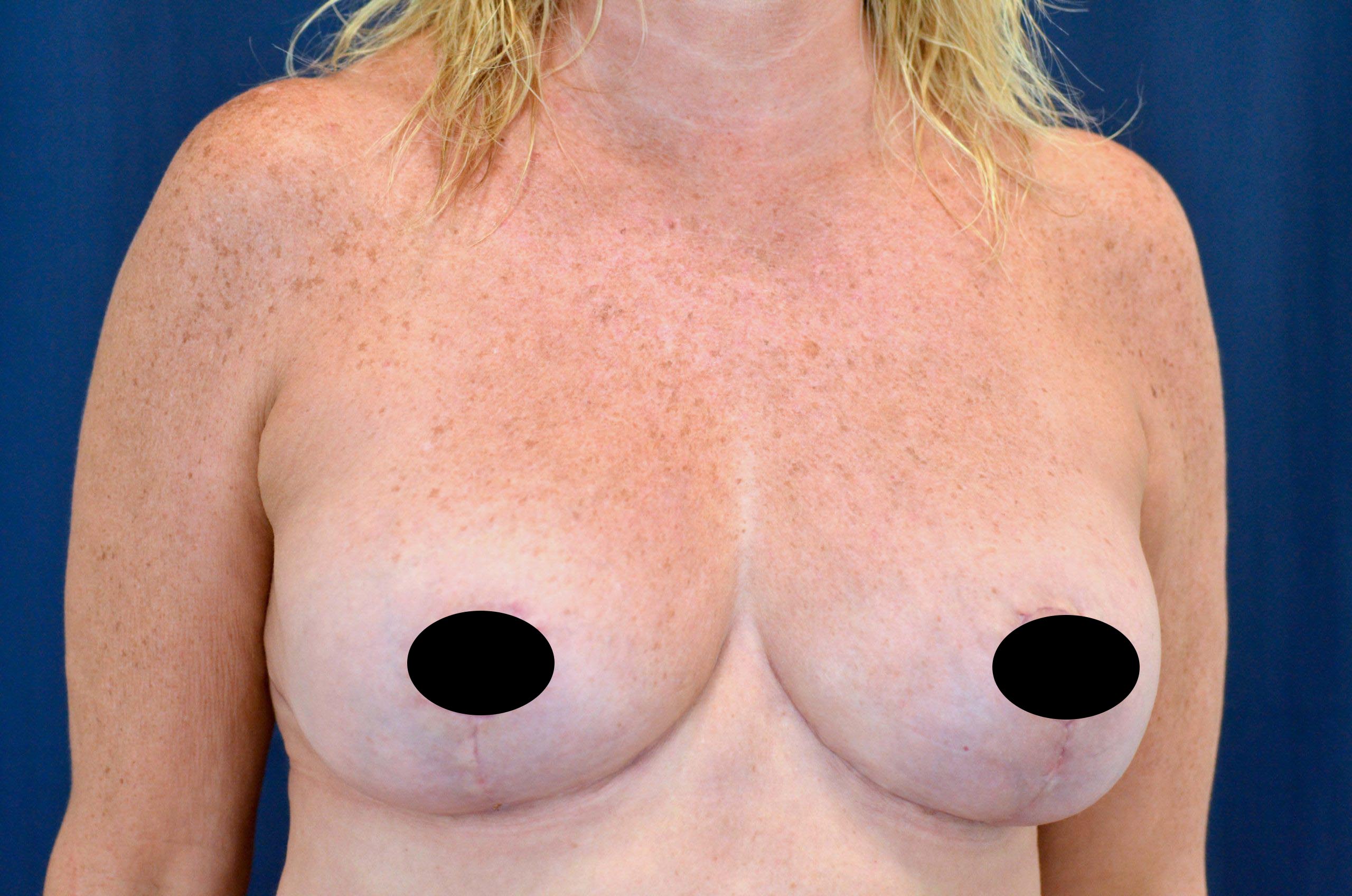 Breast Lift Reduction