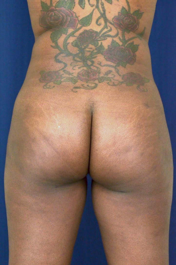 Brazilian Butt Lift Before & After