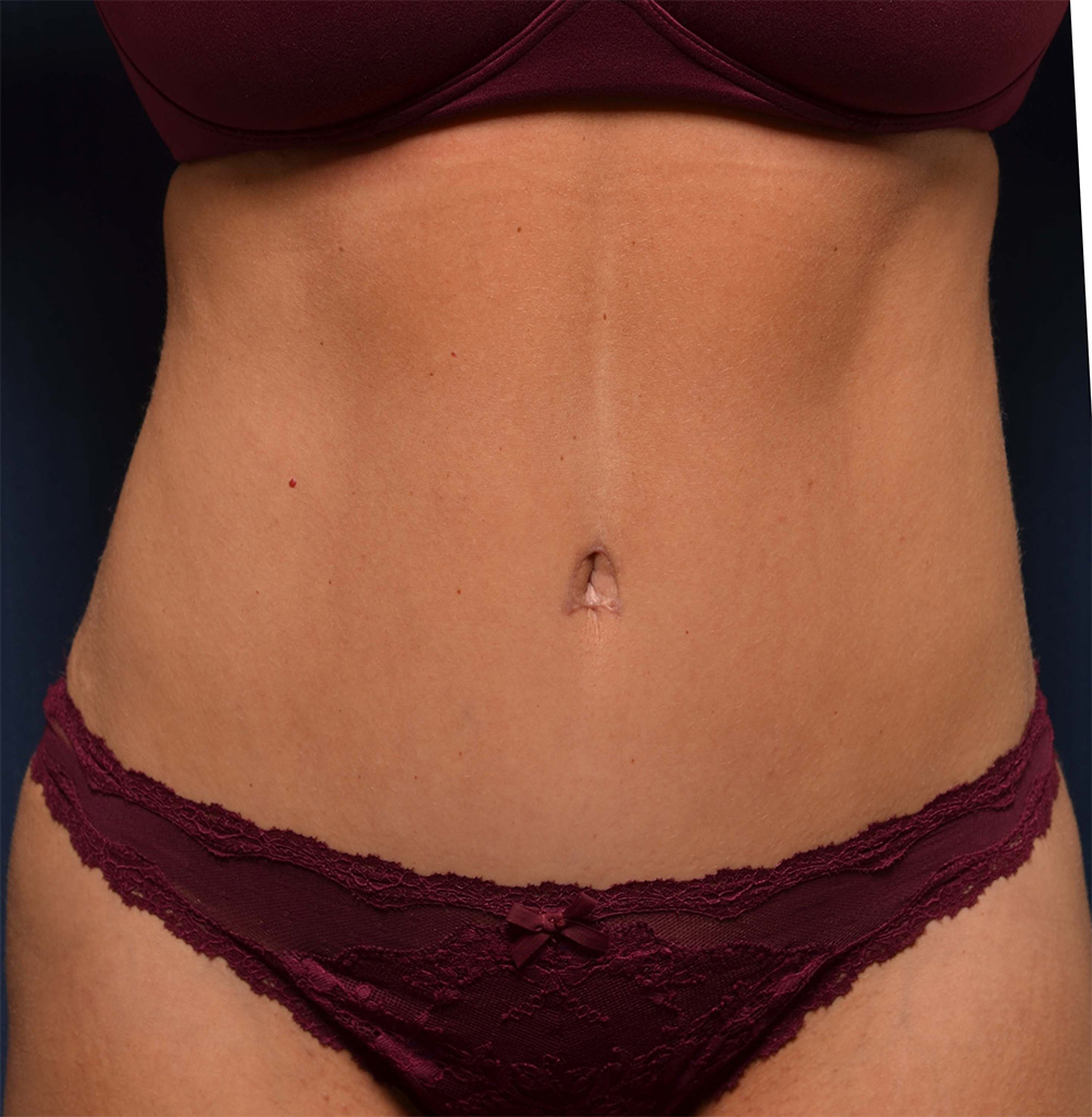 Tummy Tuck