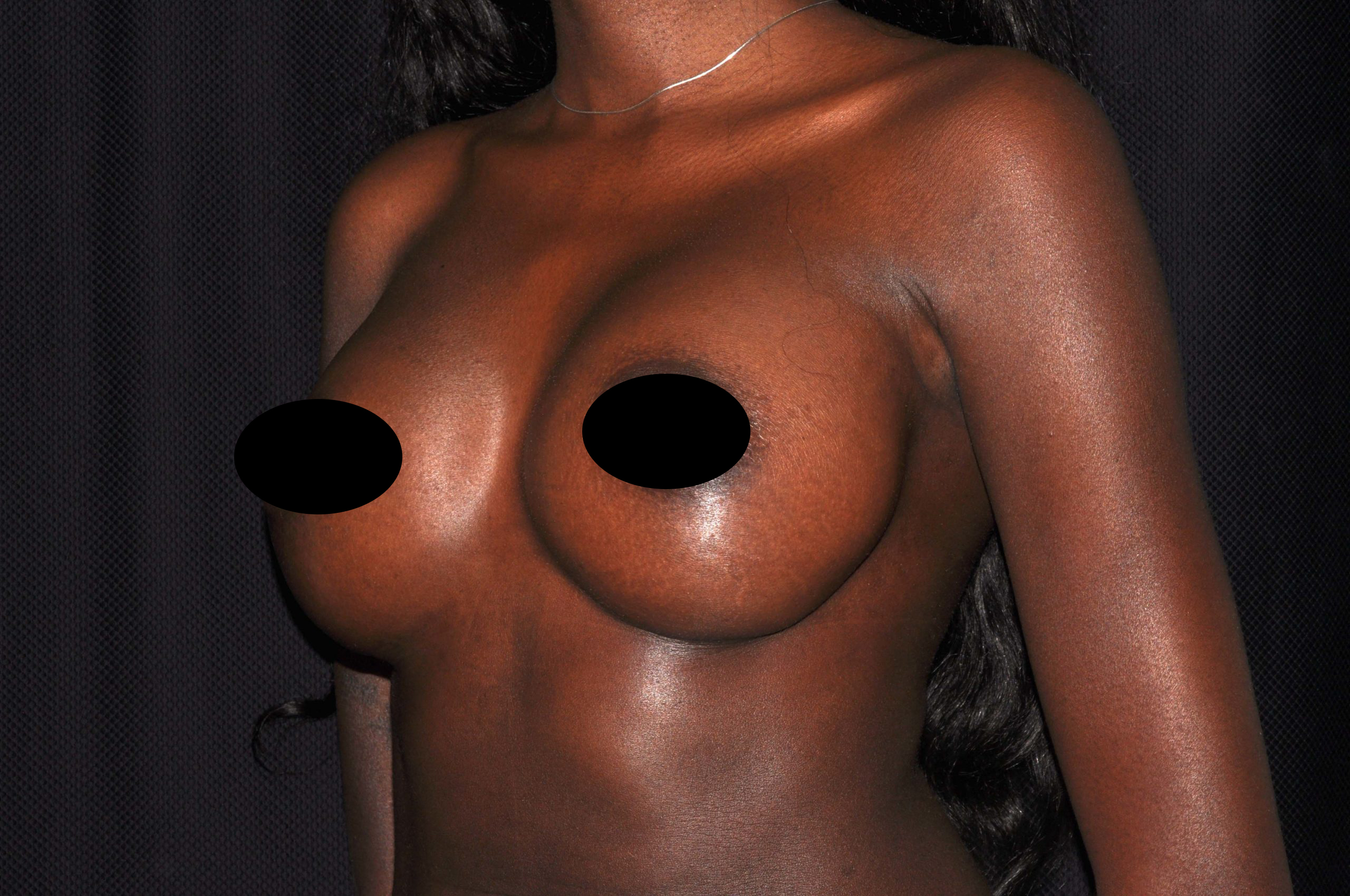 Breast Augmentation Before and After