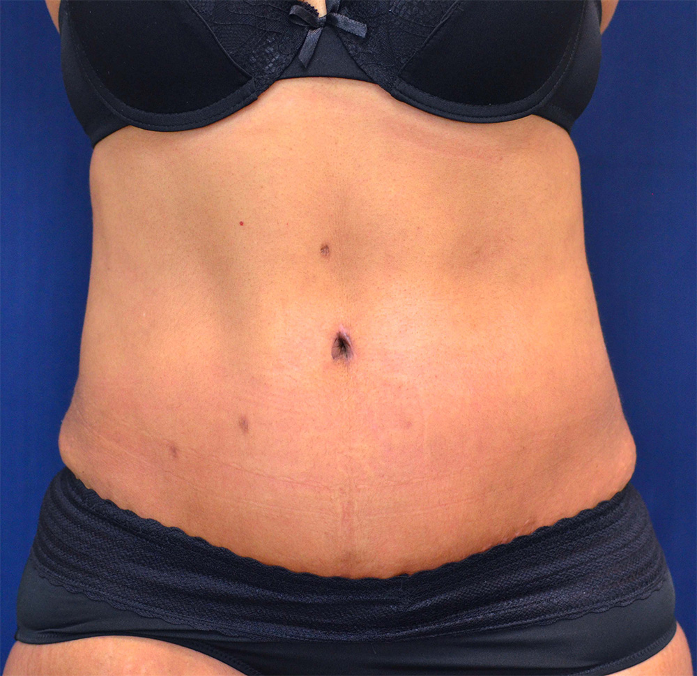 Tummy Tuck