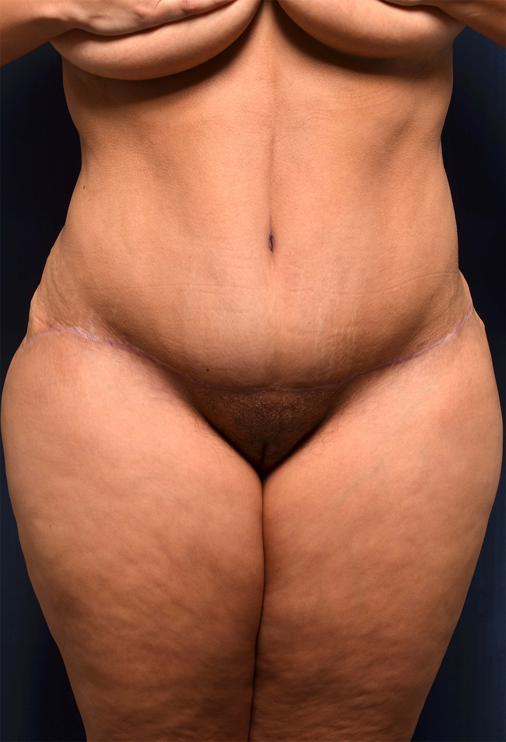 Tummy Tuck