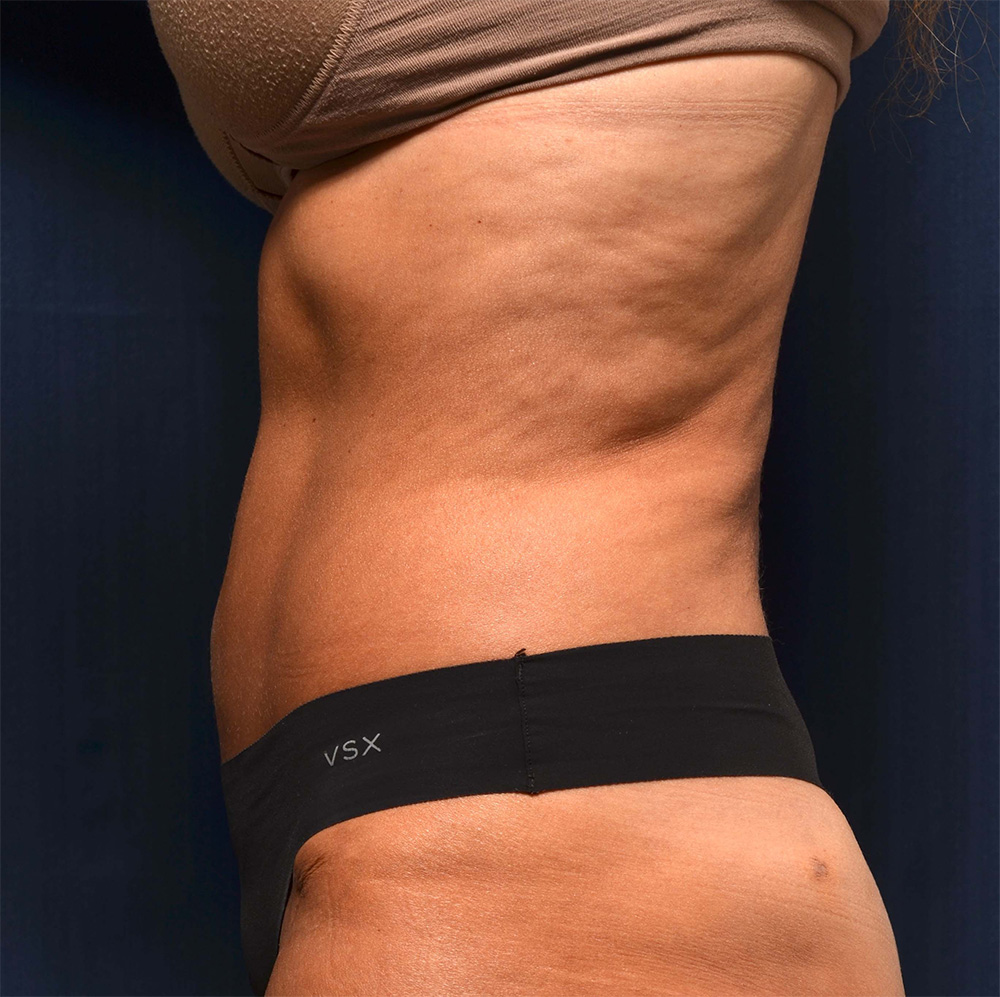 Tummy Tuck