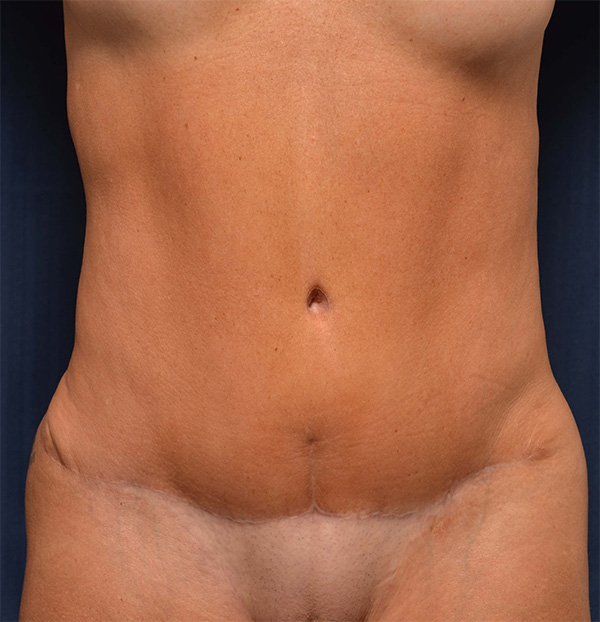 Tummy Tuck