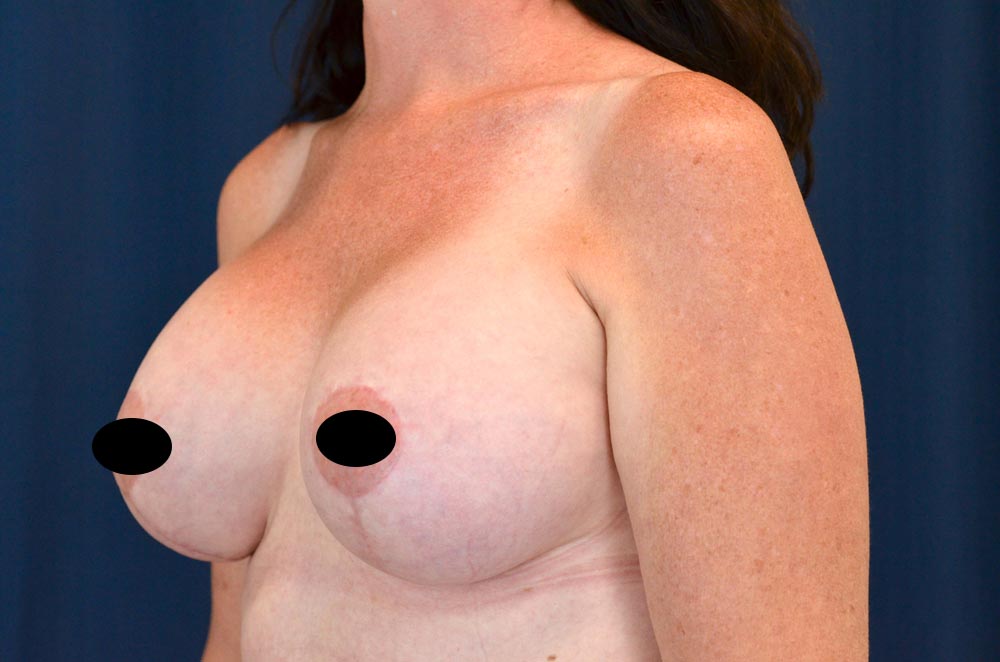 Breast Augmentation with Lift