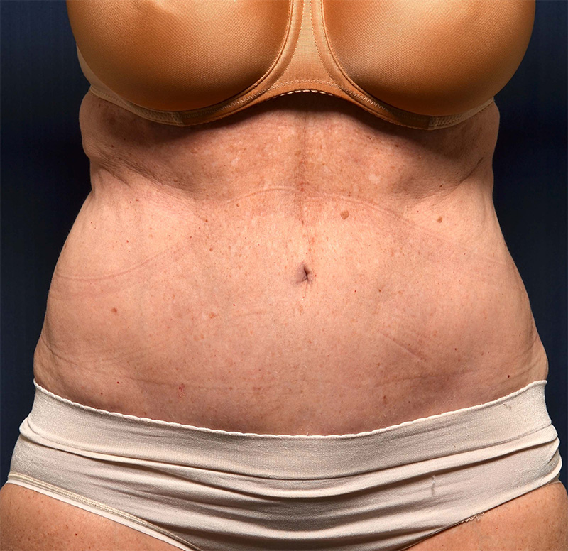 Tummy Tuck