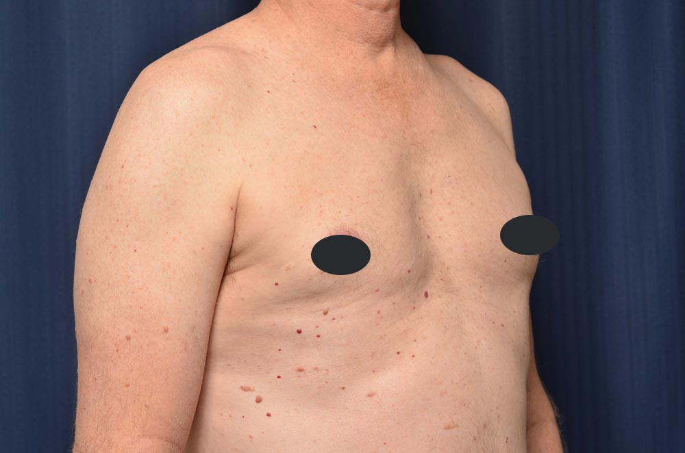 Gynecomastia