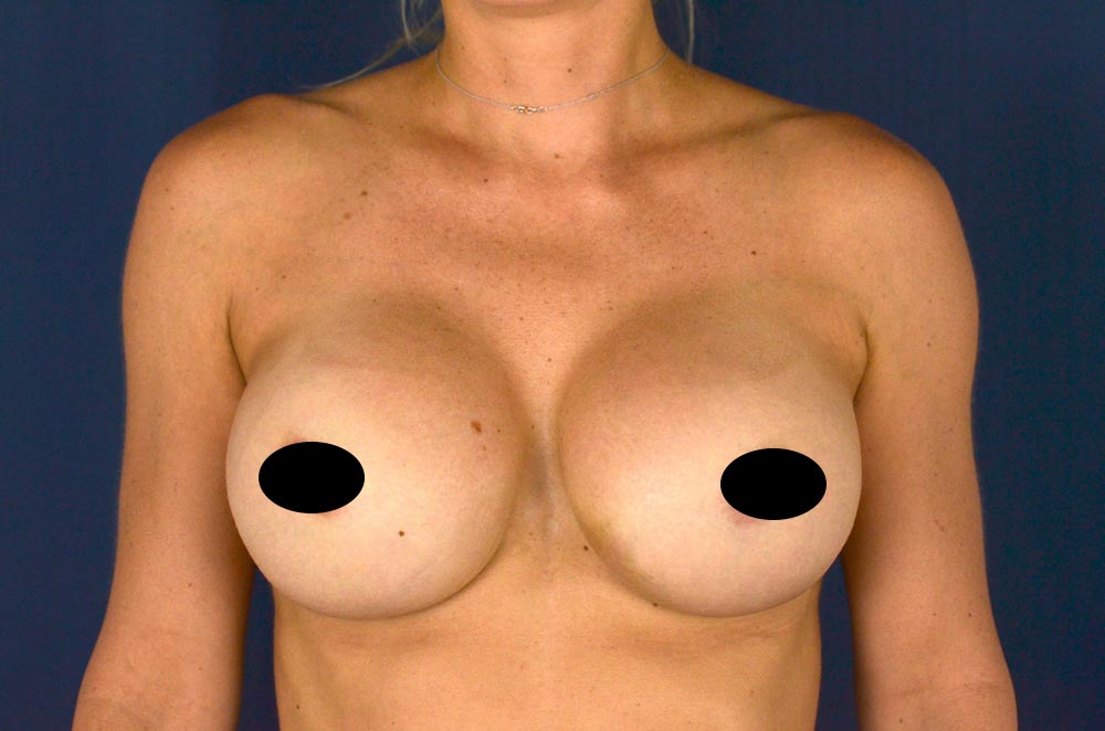 Breast Implant Revision