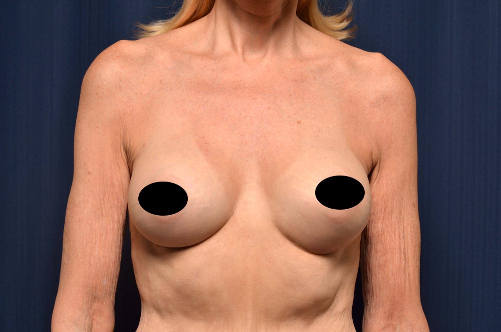 Breast Augmentation Before and After