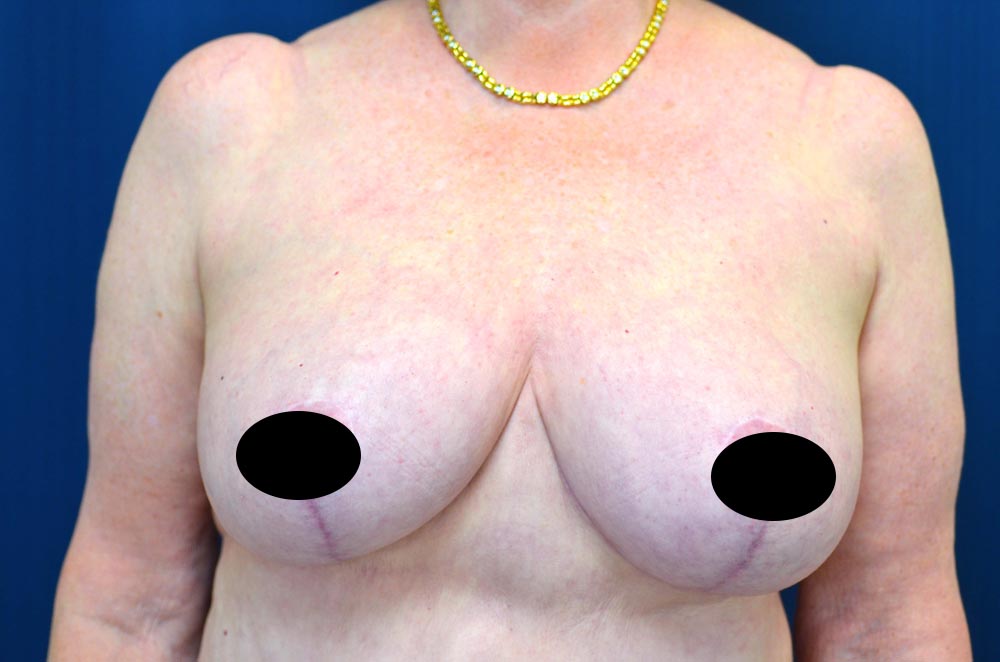 Breast Lift Reduction