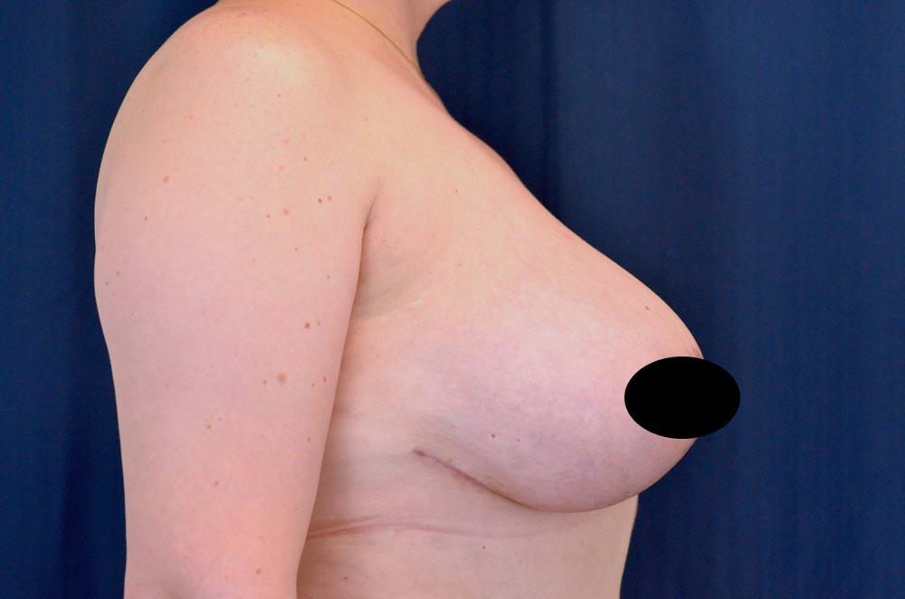 Breast Lift Reduction