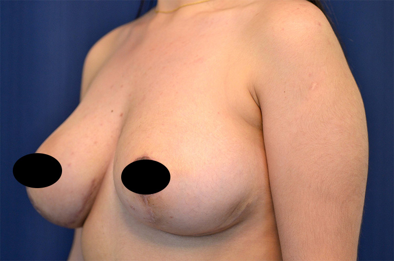 Breast Lift Reduction