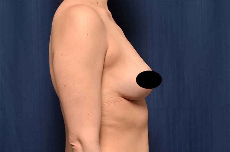 Breast Lift Reduction