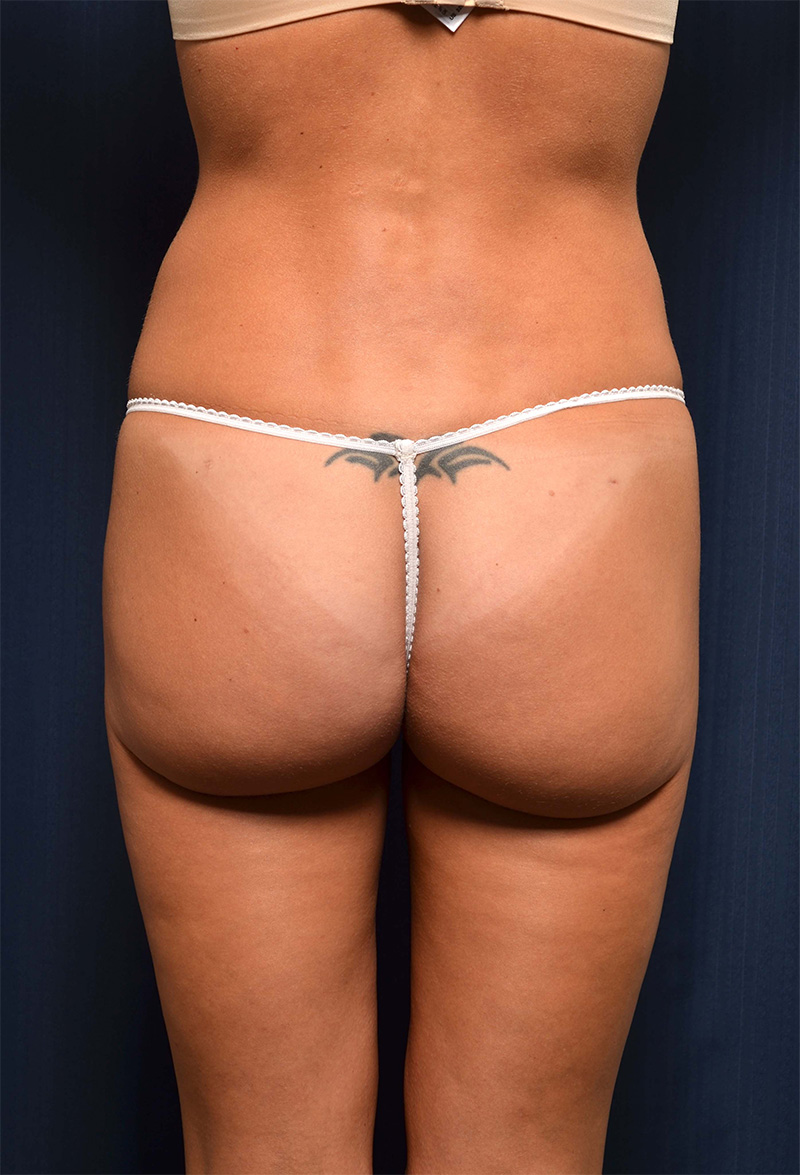 Brazilian Butt Lift Before & After