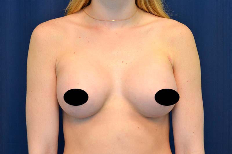 Breast Augmentation Before and After