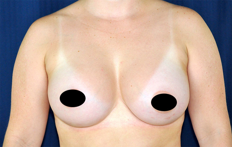 Breast Augmentation Before and After