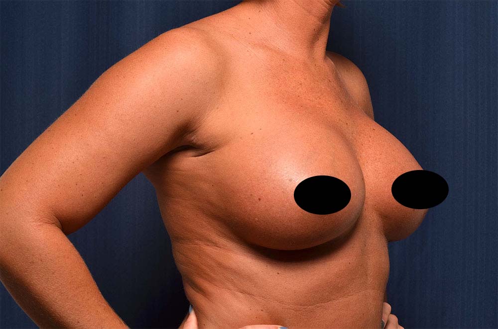 Breast Augmentation Before and After