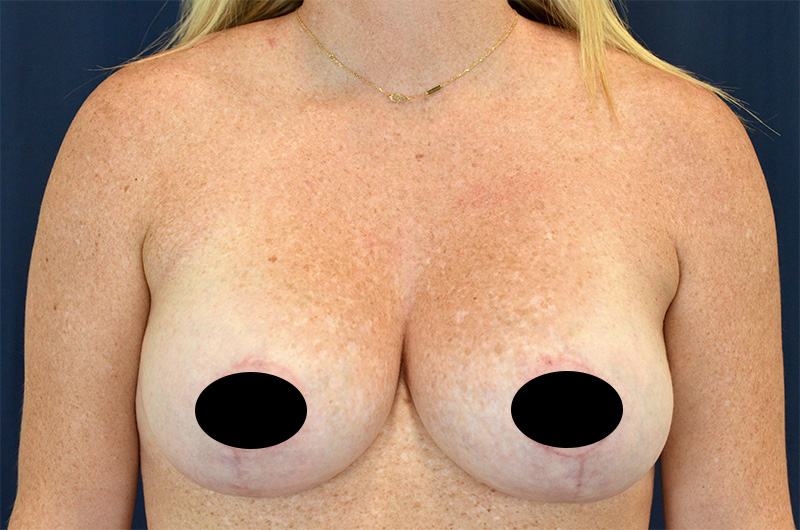 Breast Augmentation with Lift