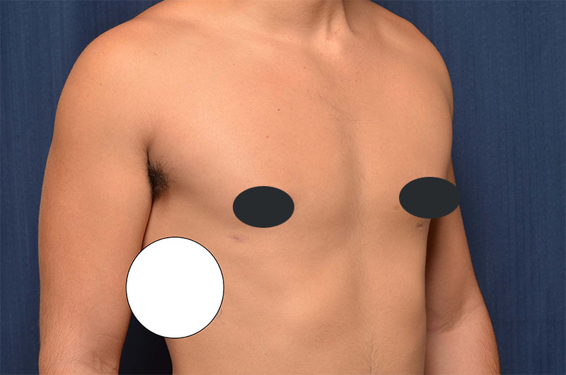 Gynecomastia