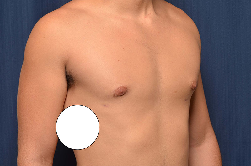 Gynecomastia
