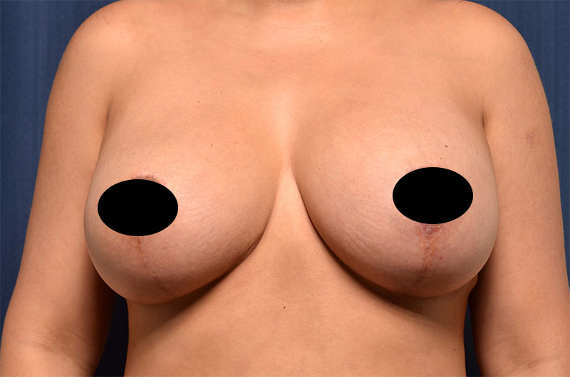 Breast Implant Revision